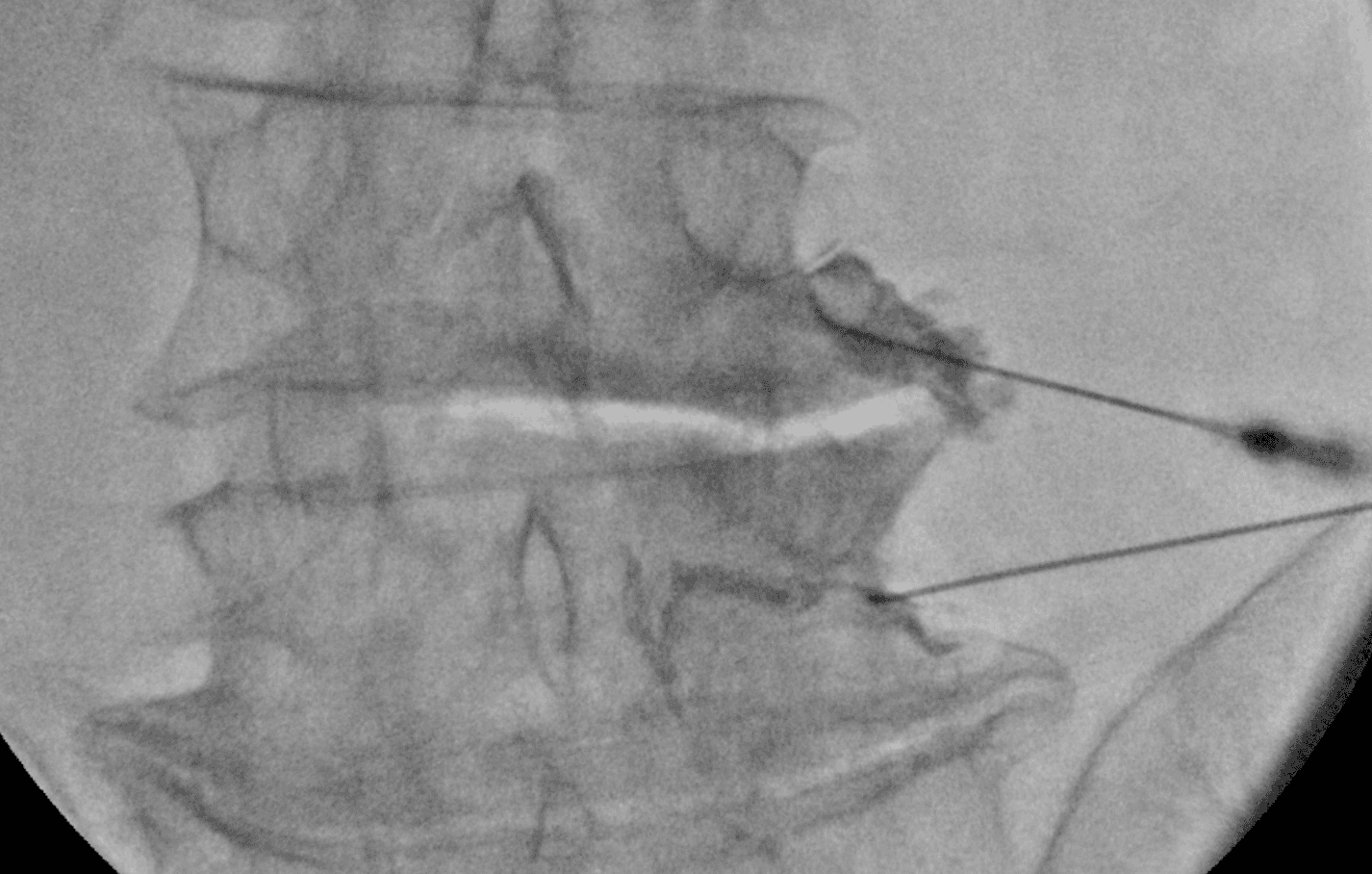 Fluoroscopic image of a Right L4 and L5 Transforaminal Epidural Injection performed correctly, with contrast outlining the exiting nerves and flowing into the epidural space