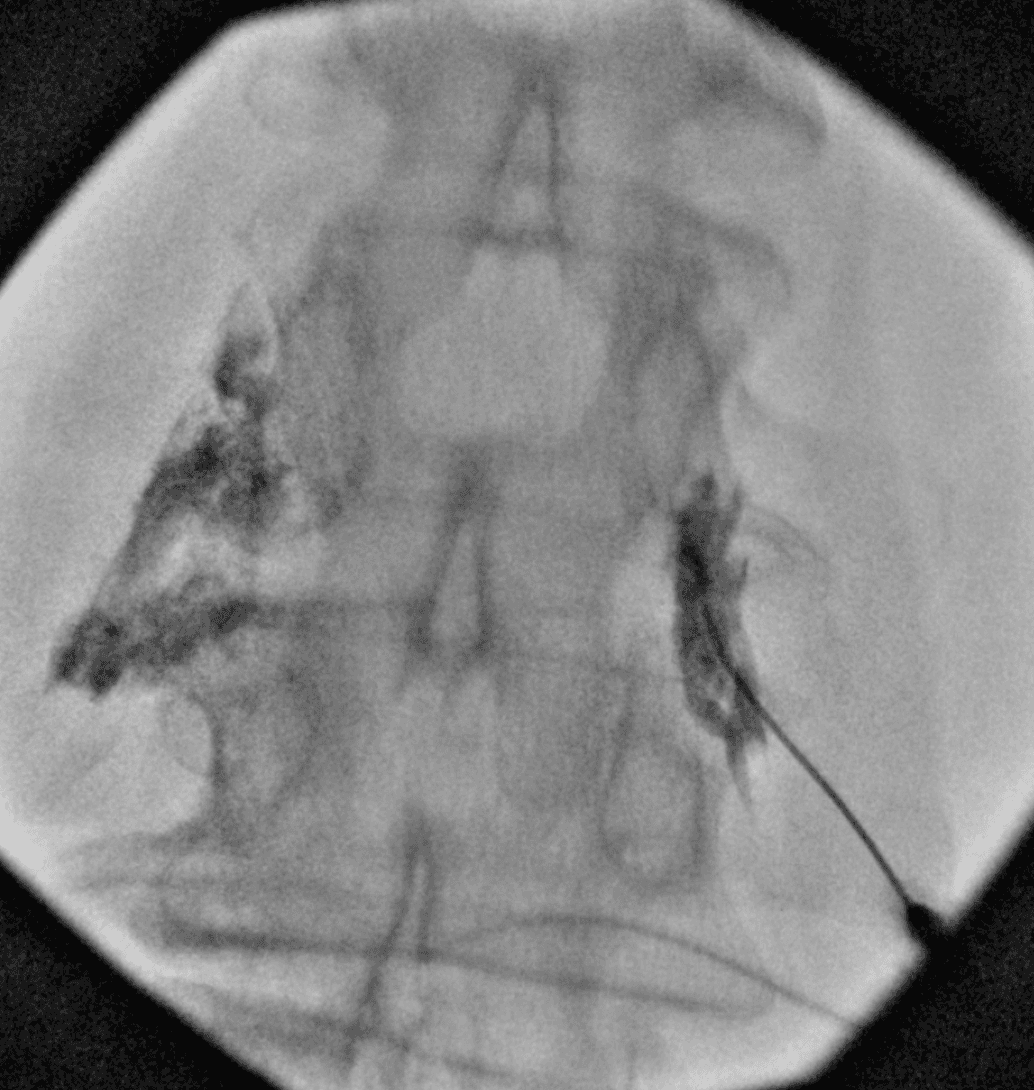 Fluoroscopic image of a Bilateral L3 Transforaminal Epidural Injection performed incorrectly, with contrast spreading outside the neuroforamen