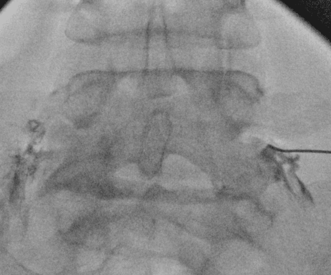 Fluoroscopic image of a Bilateral L5 Transforaminal Epidural Injection performed incorrectly, with contrast spreading outside the neuroforamen